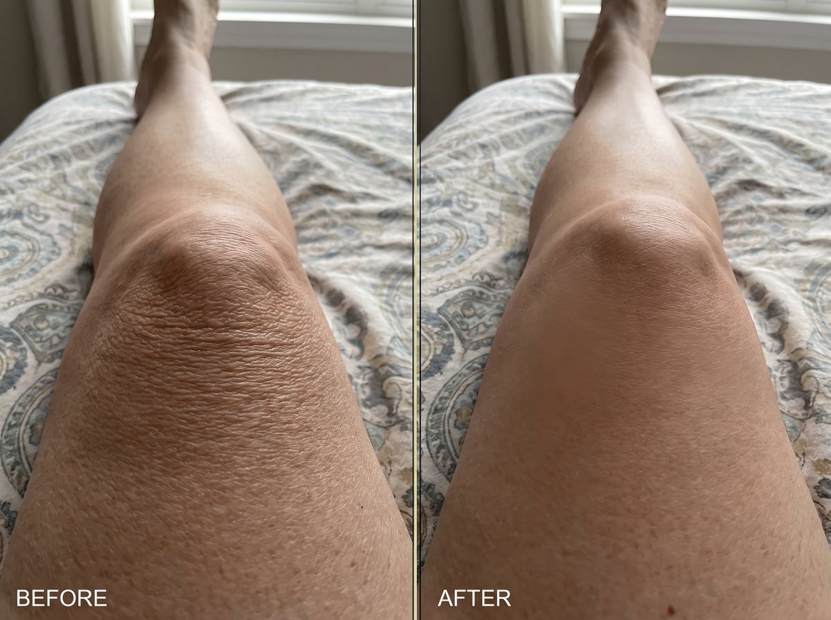Before and after: firmer, smoother skin above the knee